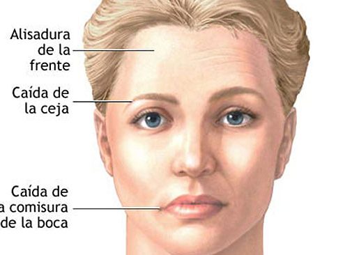 paralisis facial acupuntura