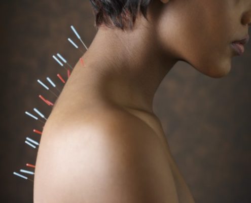 avances-acupuntura