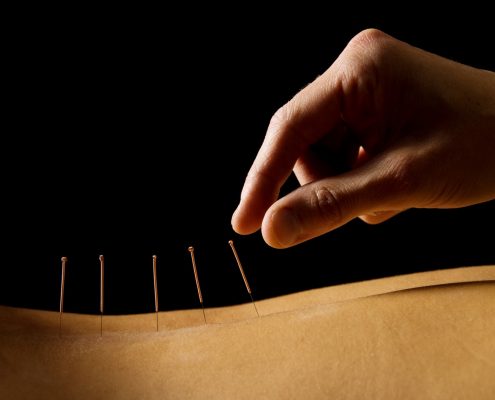 acupuntura-espalda