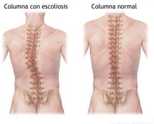 columna escoliosis acupuntura